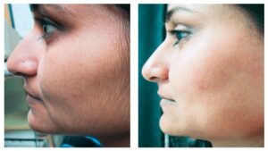 Laser hair removal slider