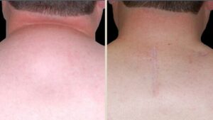 Lipoma removal slider