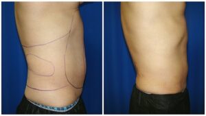 Liposuction slider