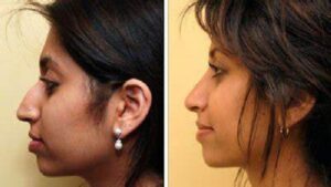 Rhinoplasty slider