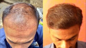 hair transplant slider