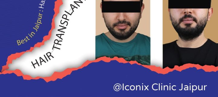 dr abhimanyu hair transplant